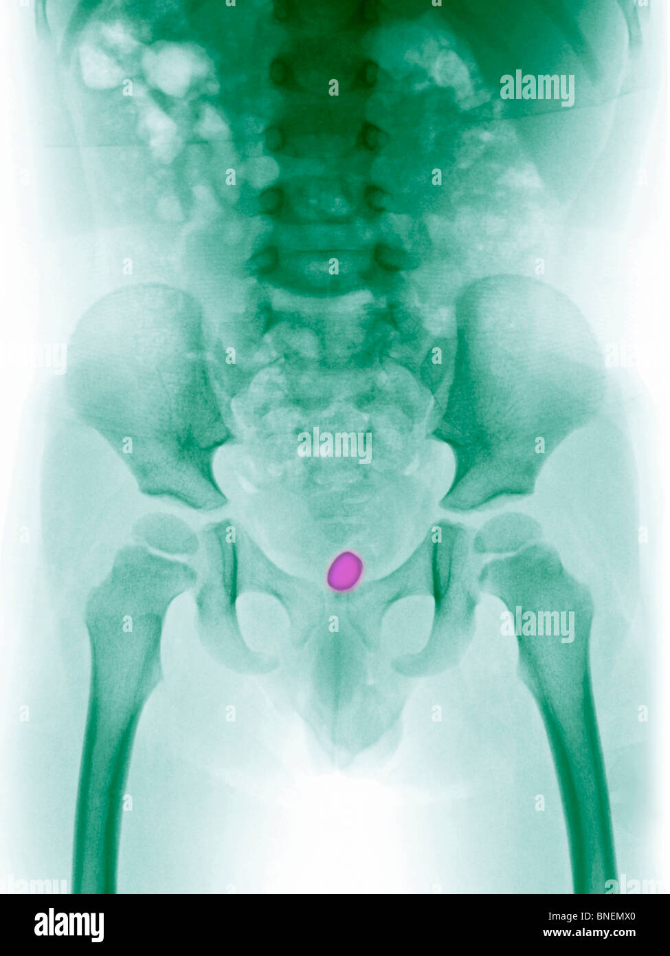 abdomen x-ray of a 3 year old girl who swallowed a watch battery Stock Photo
