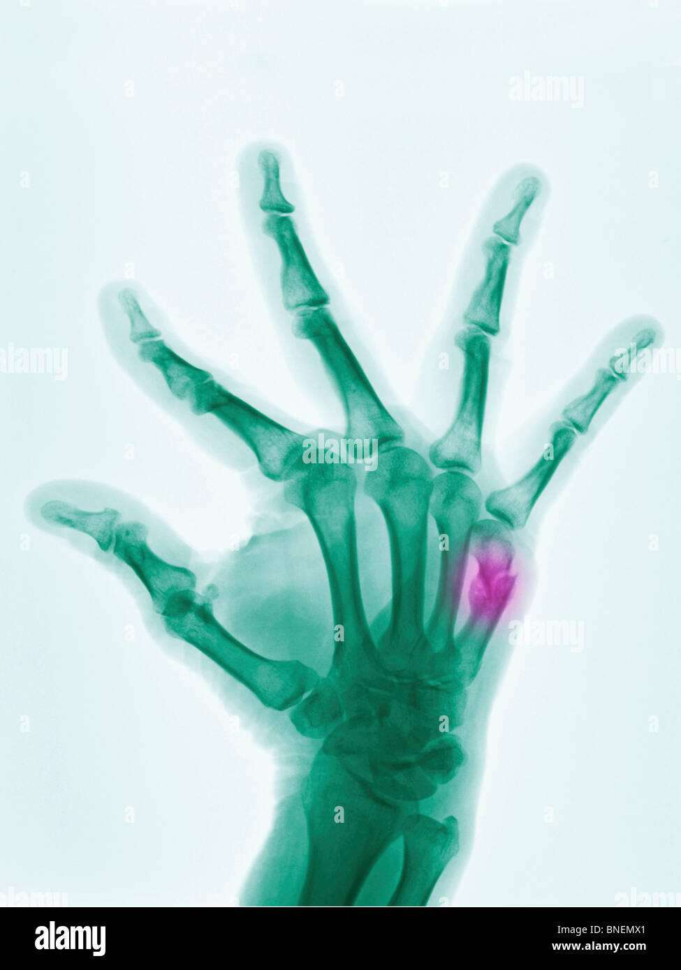 Hand x-ray showing a boxer's fracture in a 57 year old man Stock Photo