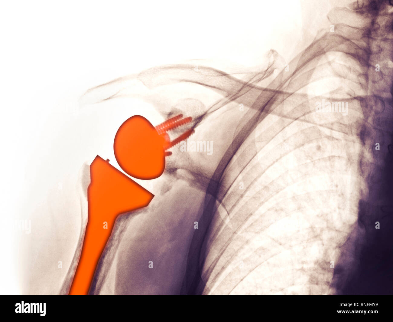 x-ray of shoulder replacement Stock Photo