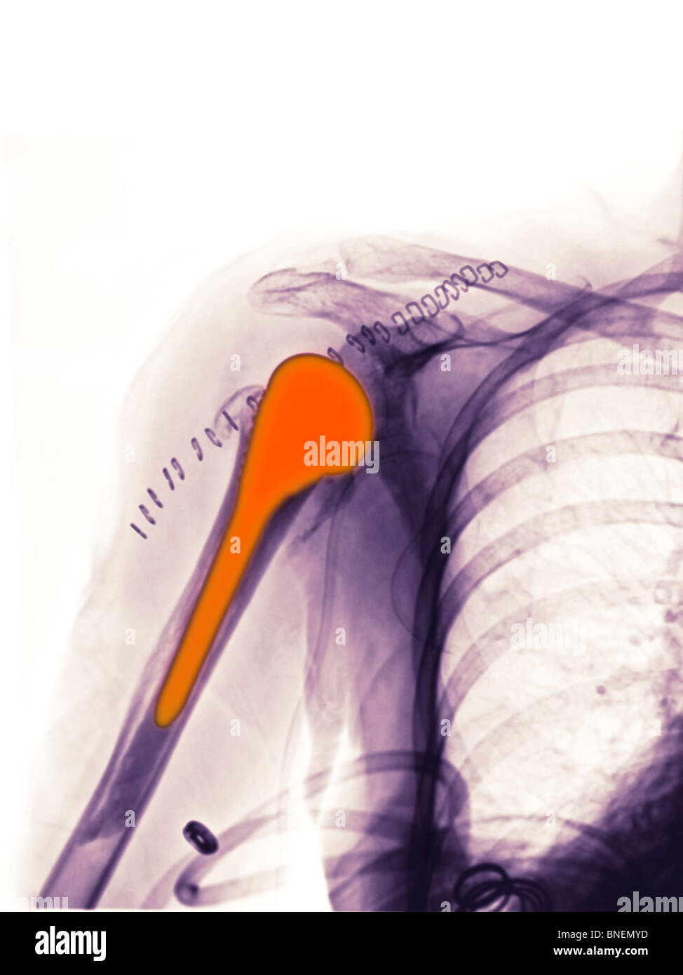x-ray showing shoulder replacement Stock Photo