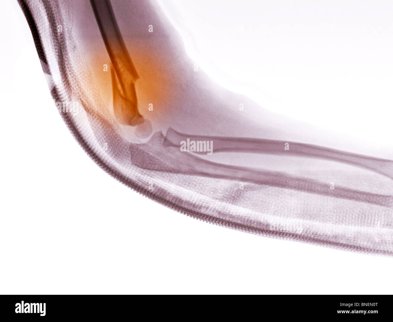 X-ray of a fracture of the distal humerus Stock Photo