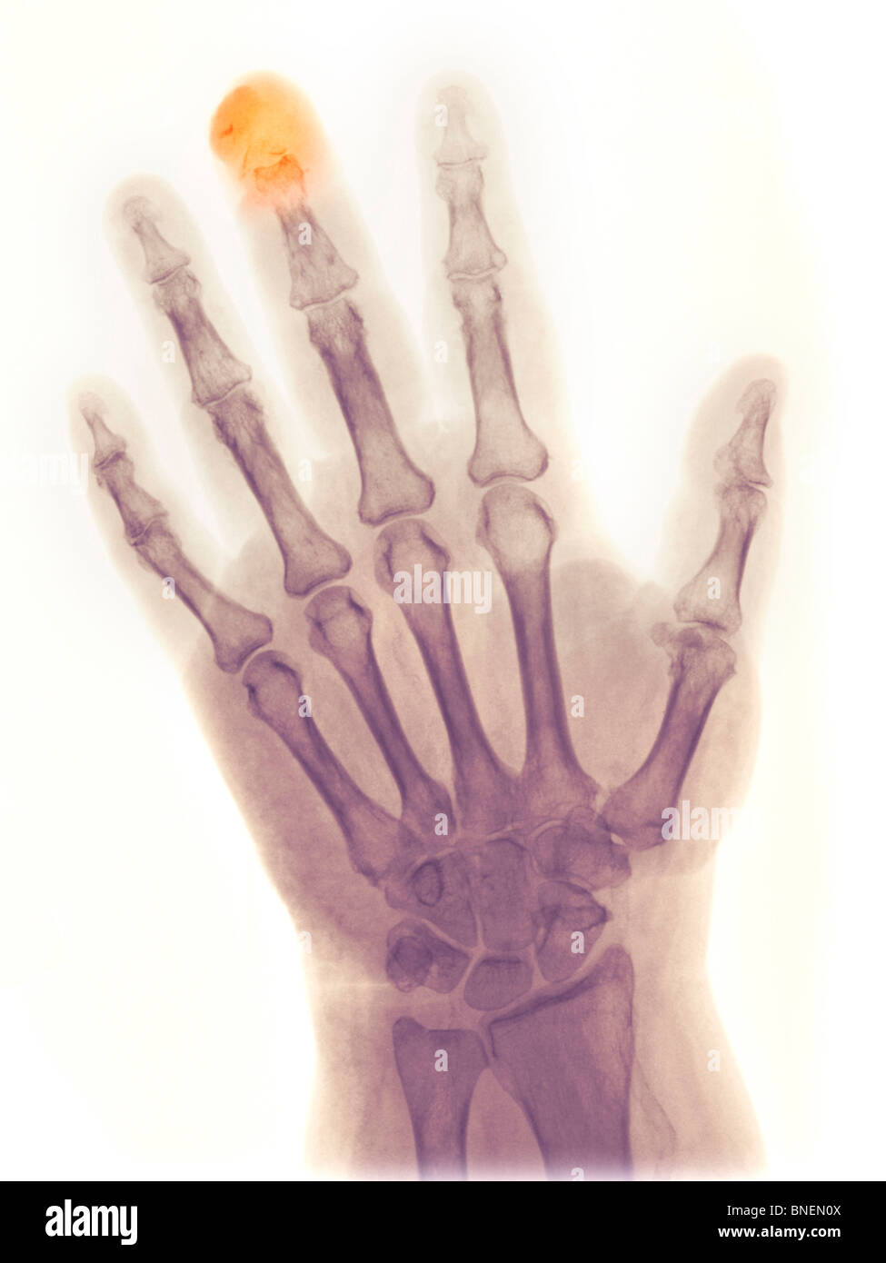 X-ray of the hand showing fractured distal phalanx Stock Photo
