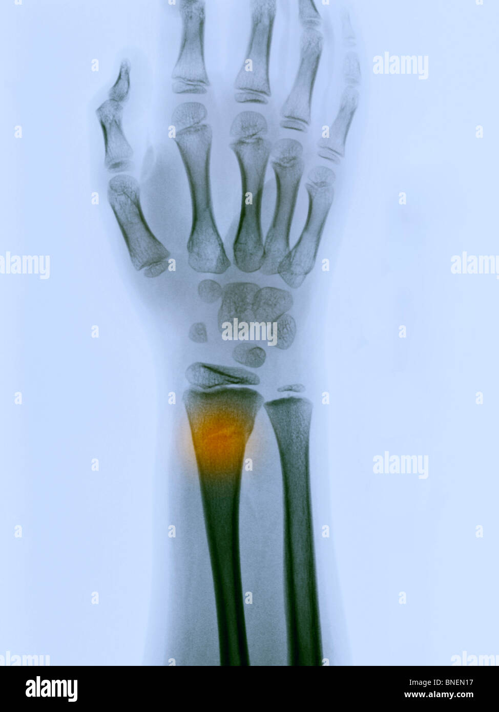 xray showing a greenstick fracture of the distal radius Stock Photo