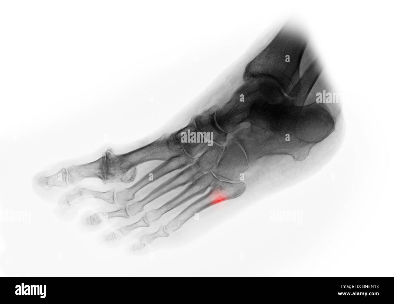 foot x-ray fractured  base of 5th metatarsal Stock Photo