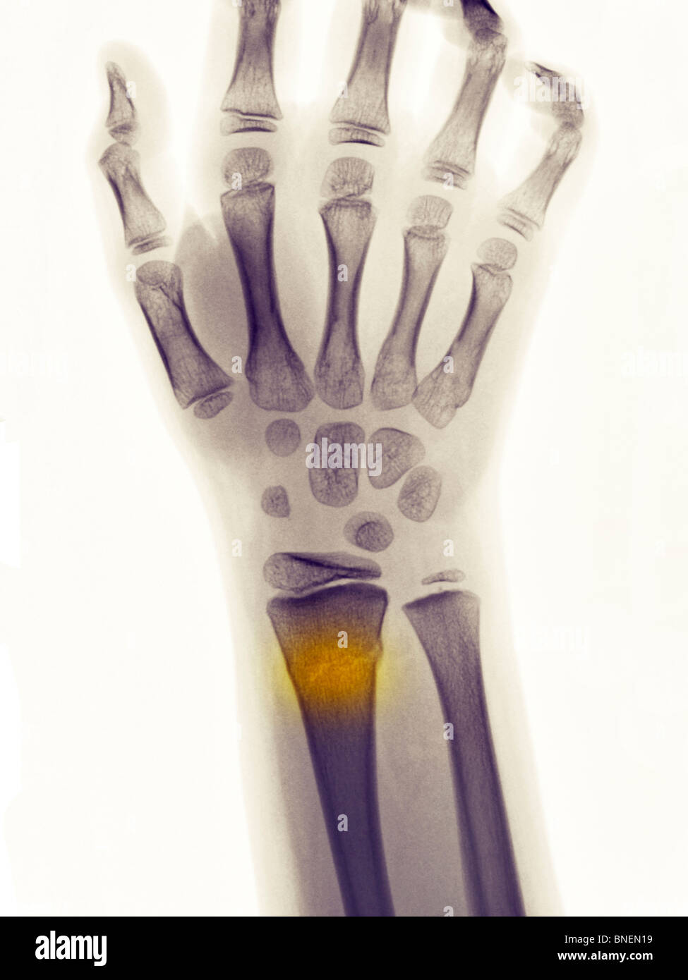 x-ray showing a greenstick fracture of the distal radius Stock Photo