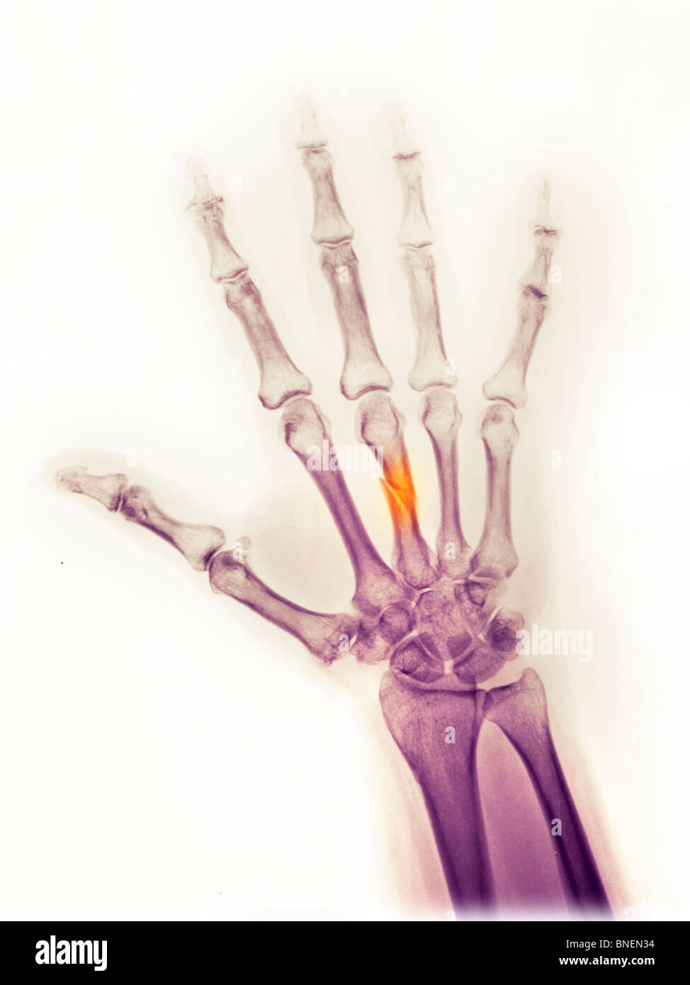 Hand x-ray of a fractured  middle metacarpal Stock Photo