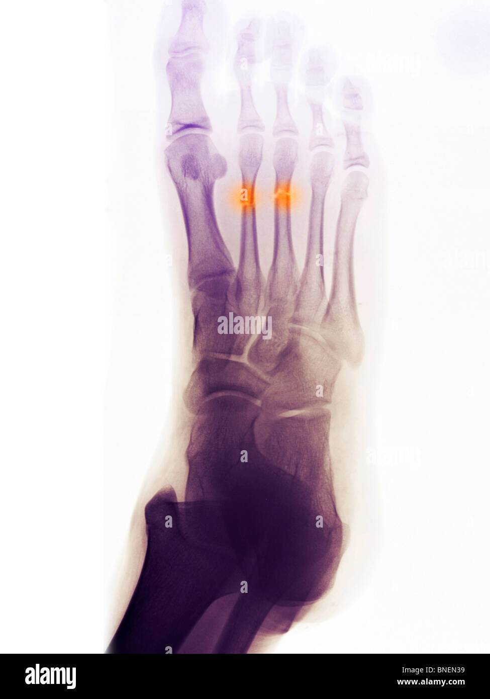 Foot x-ray showing fractured 2nd and 3rd metatarsals Stock Photo