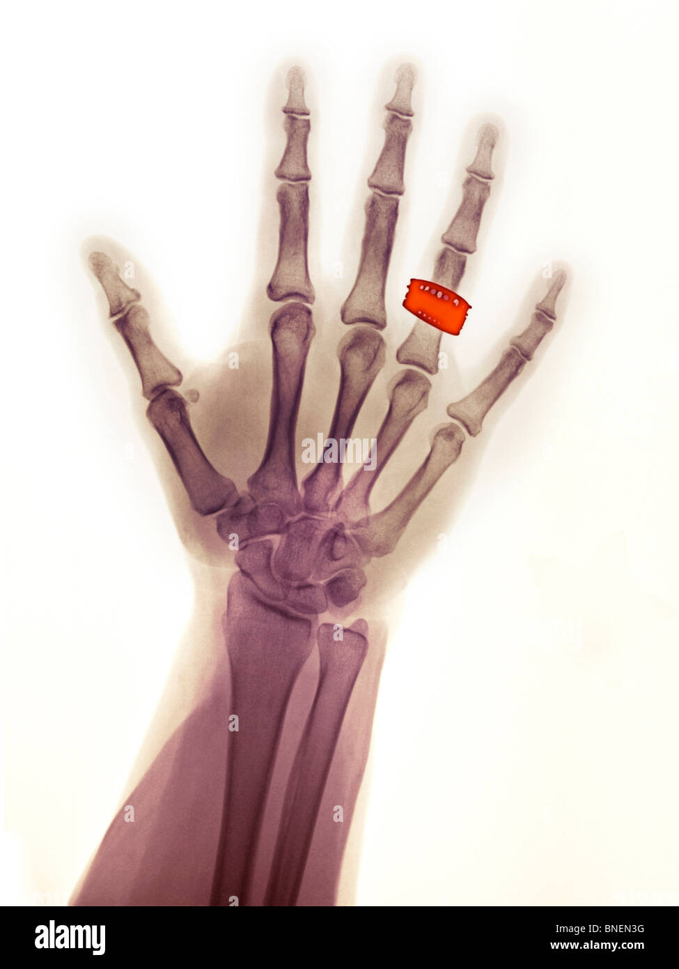 hand x-ray of woman wearing a wedding ring Stock Photo