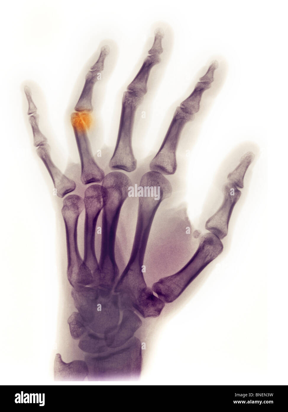 Hand x-ray showing a fracture of the ring finger Stock Photo