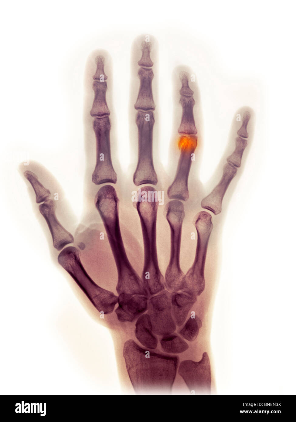 Hand x-ray showing a fractured finger Stock Photo