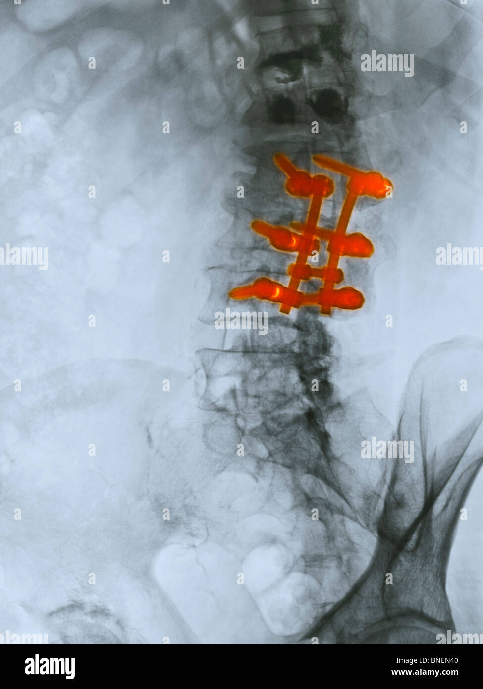Lumbar spine x-ray of an 80 year old man who underwent a spinal fusion operation Stock Photo