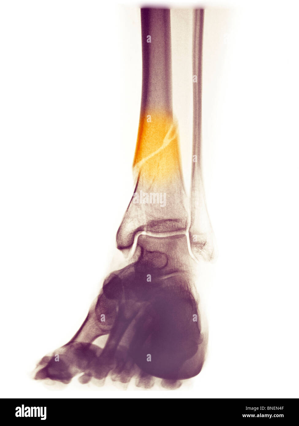 x-ray of lower leg fracture Stock Photo