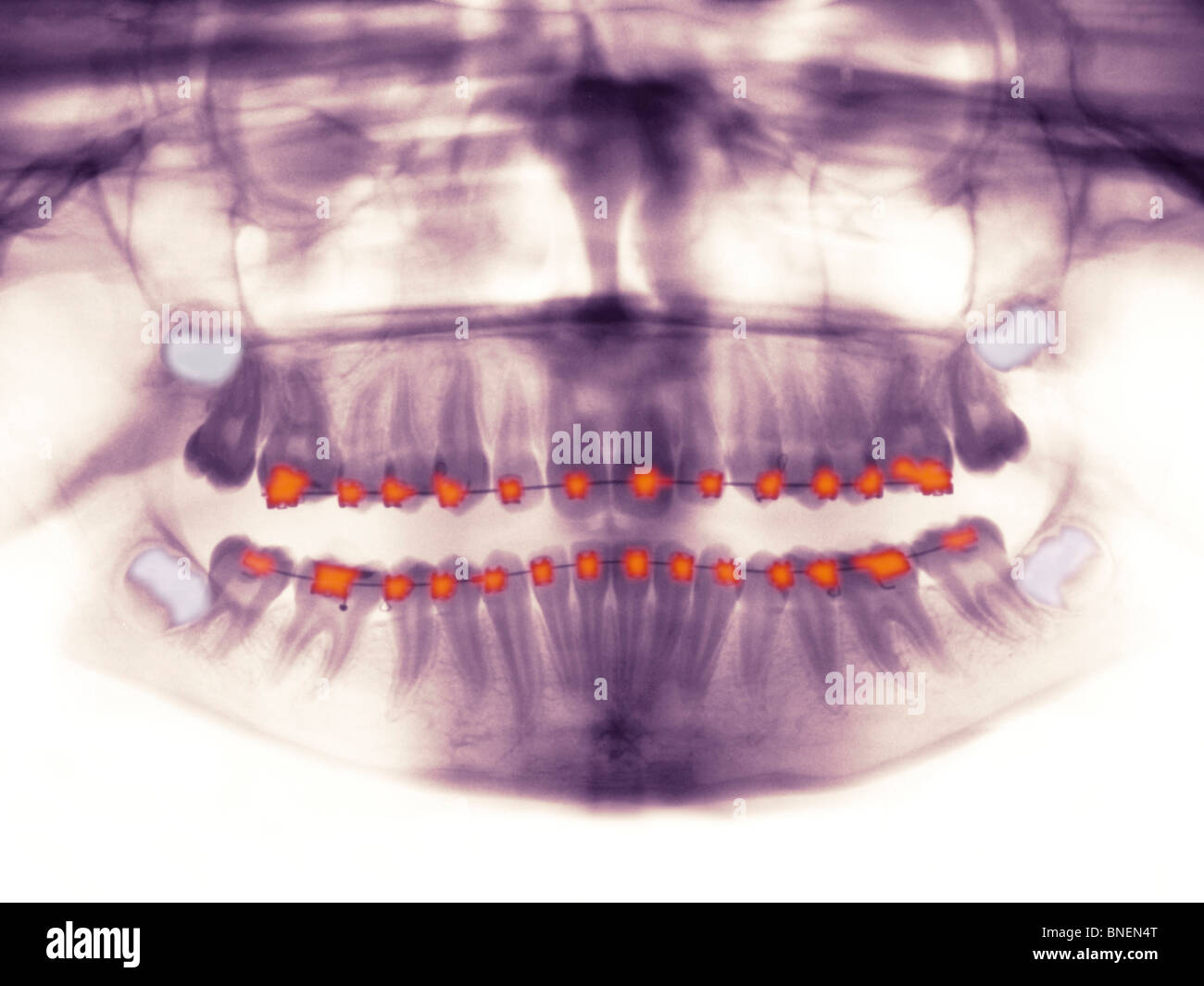 orthodontics teen selfie nude 1,640 Girl Smiling Straight Teeth Stock Photos - Free & Royalty-Free Stock  Photos from Dreamstime