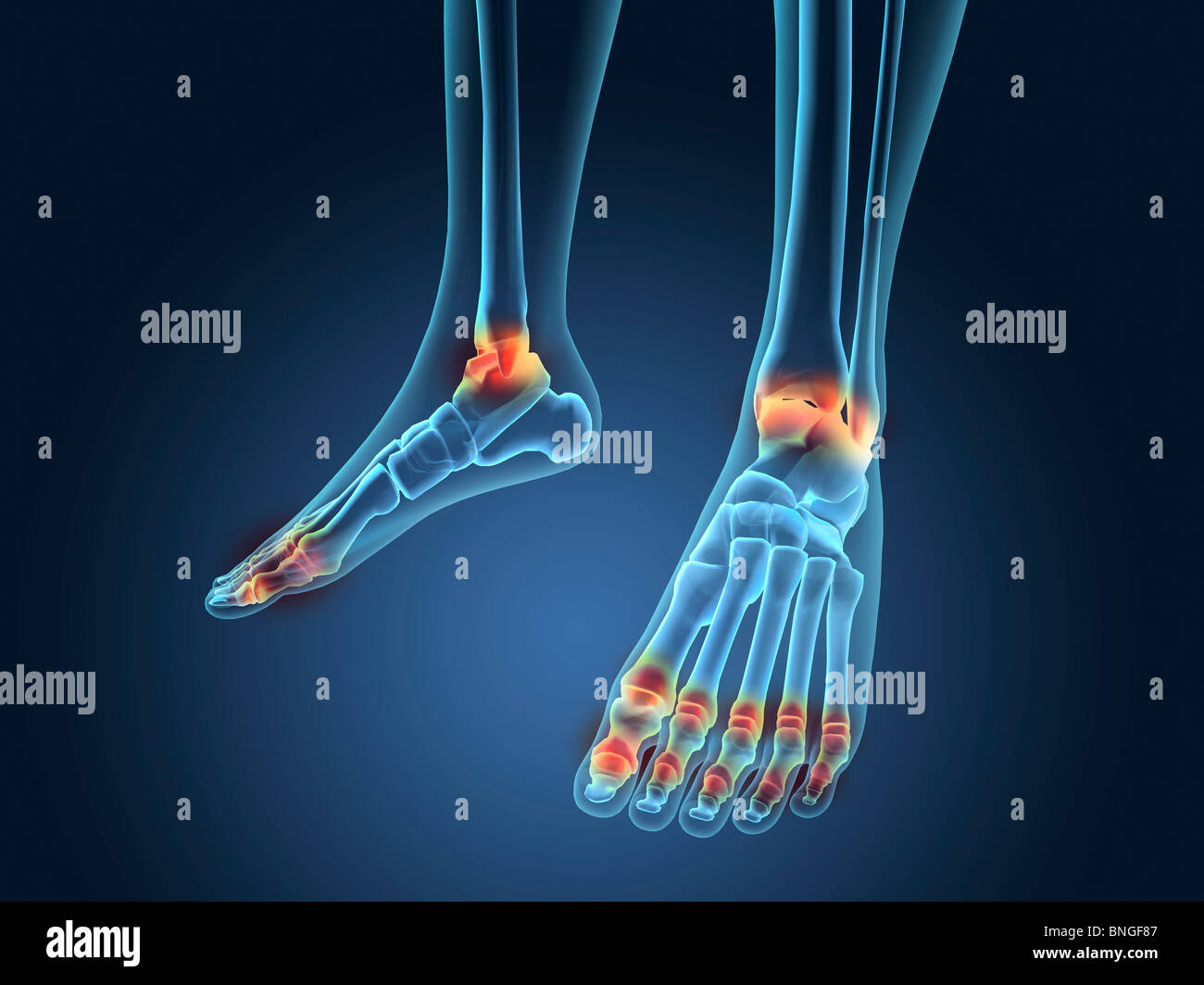 Xray view of inflamed foot bones Stock Photo Alamy