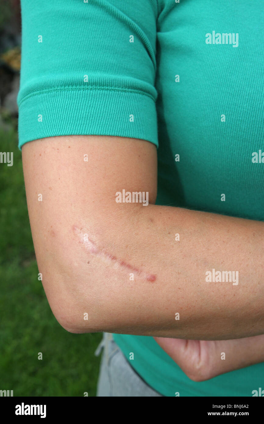 Scar on woman's right elbow. Wound was a work injury Stock Photo Alamy