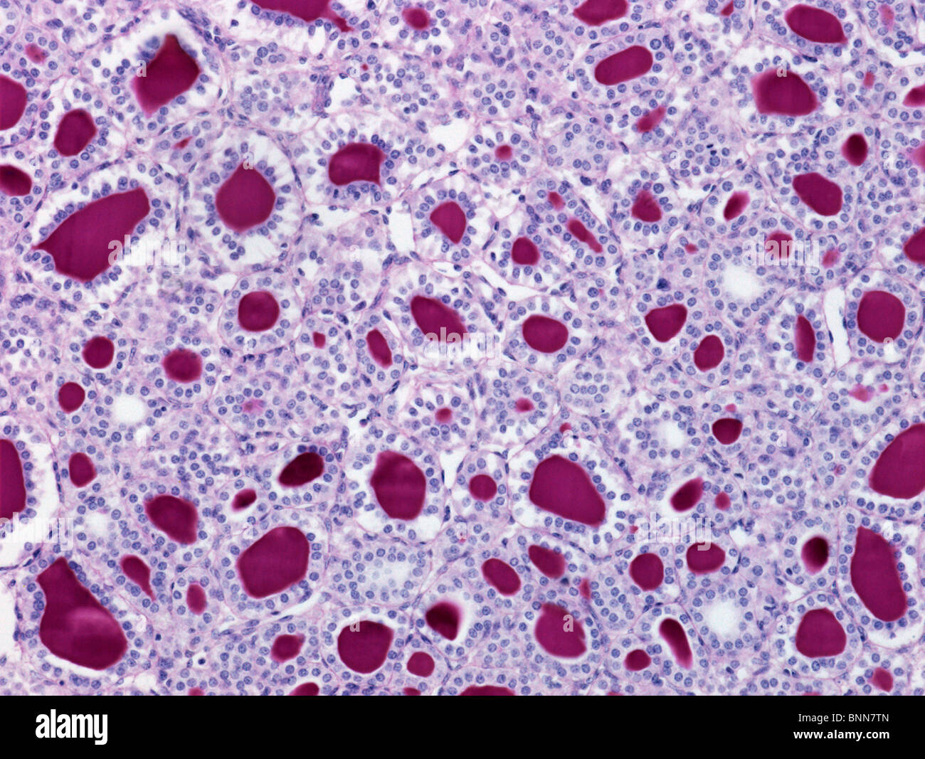 Thyroid, light micrograph Stock Photo