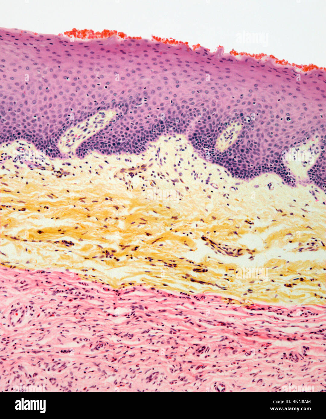 Neurofibroma, light micrograph Stock Photo