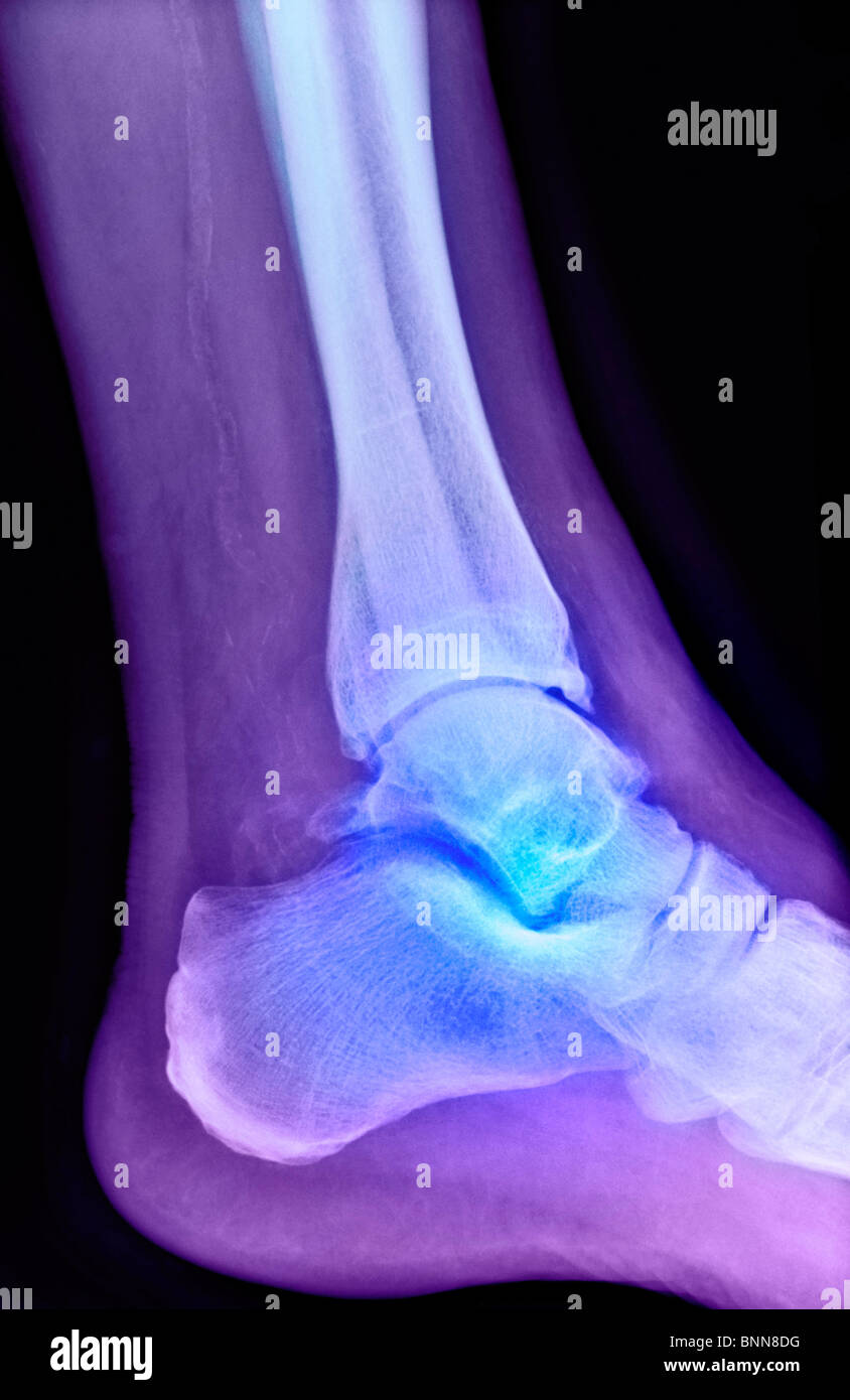 Arthritic Ankle X Ray Stock Photo Alamy