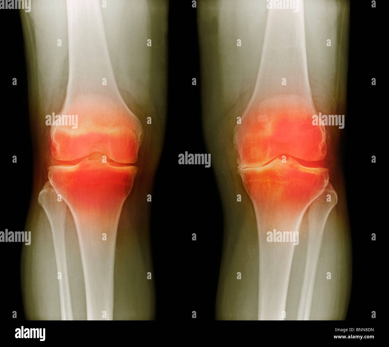 деформирующий остеоартроз (доа). деформирующий остеоартроз рентген. гонартроз можно ходить. гонартроз можно ходить. гонартроз остеоартроз.