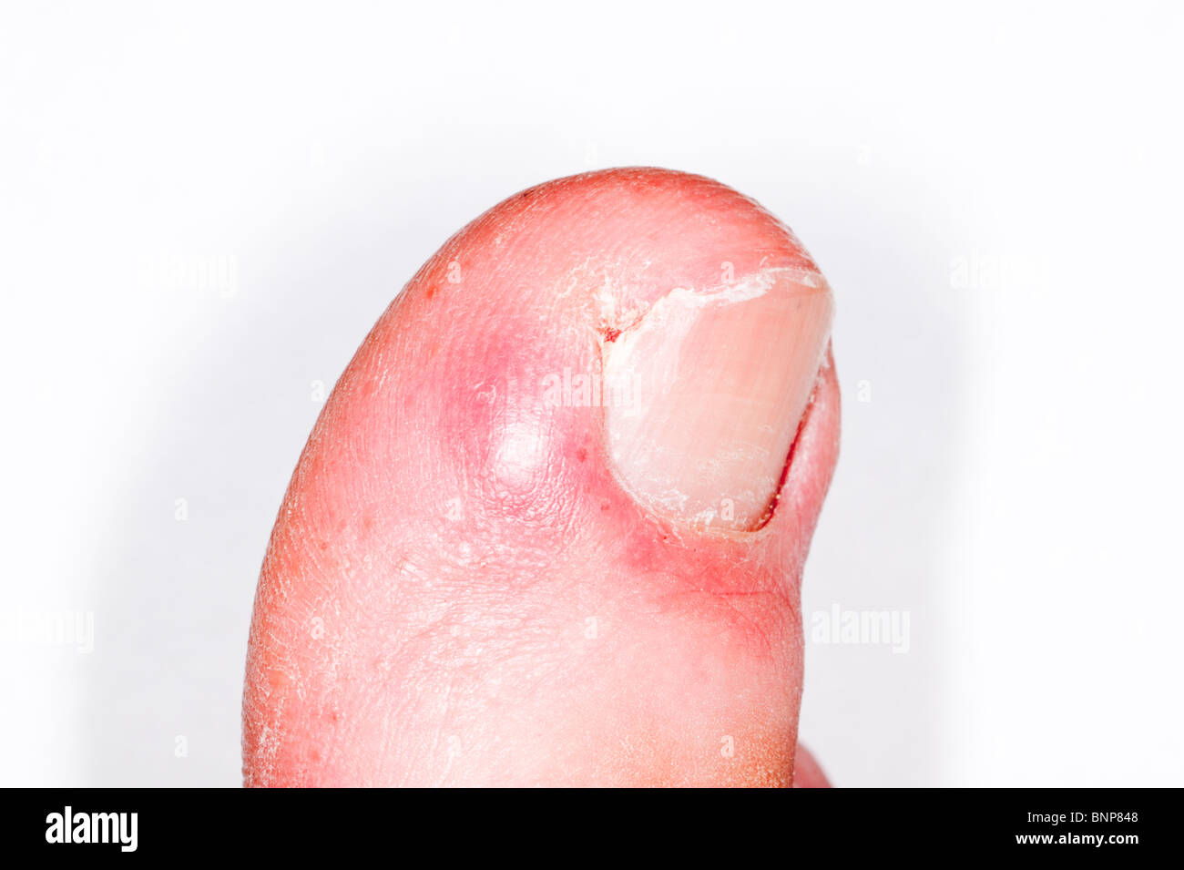 A MODEL RELEASED close up picture of an ingrown toenail ( toe nail ) in the Uk Stock Photo
