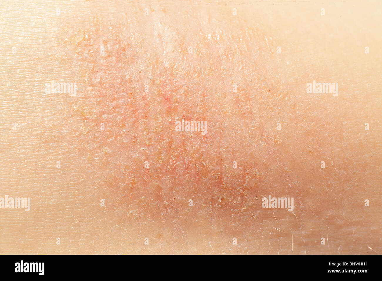 macro of eczema on little girl arm skin Stock Photo
