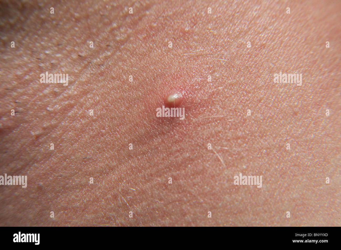 Large acne spot or pimple on a mans neck. Stock Photo