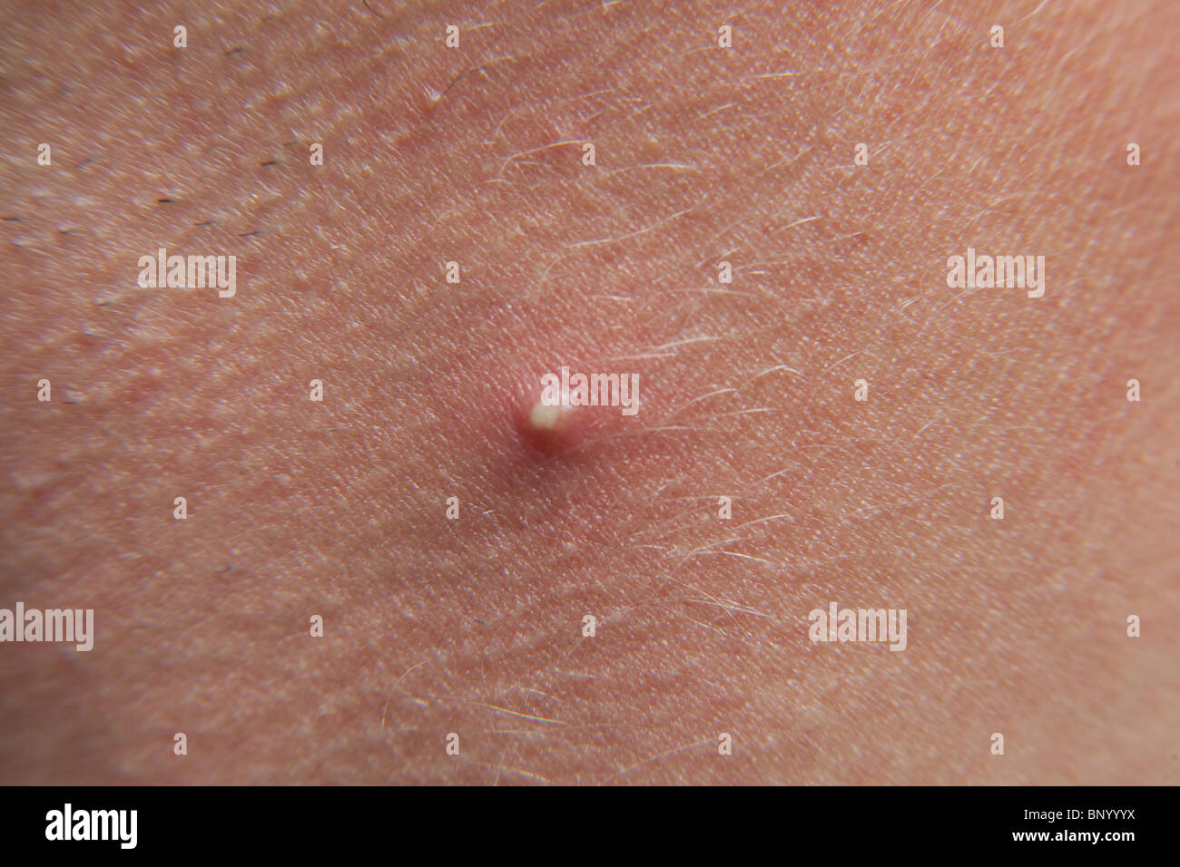 Large acne spot or pimple on a mans neck. Stock Photo