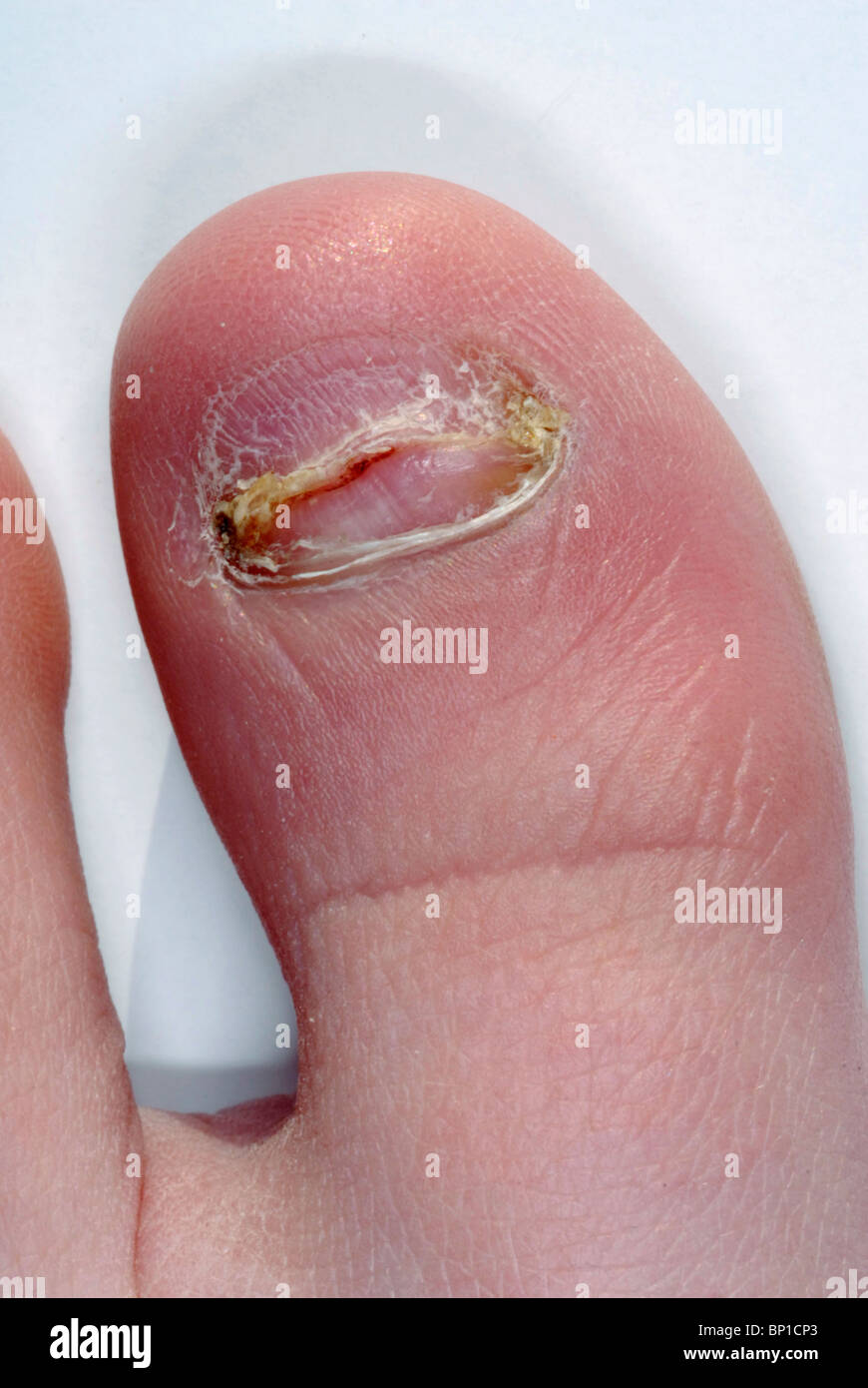 boy's foot showing bitten and picked toenails Stock Photo