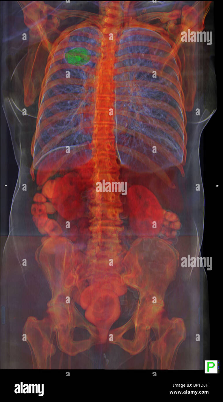 Posterior view of a 3D CT scan showing a lung cancer Stock Photo