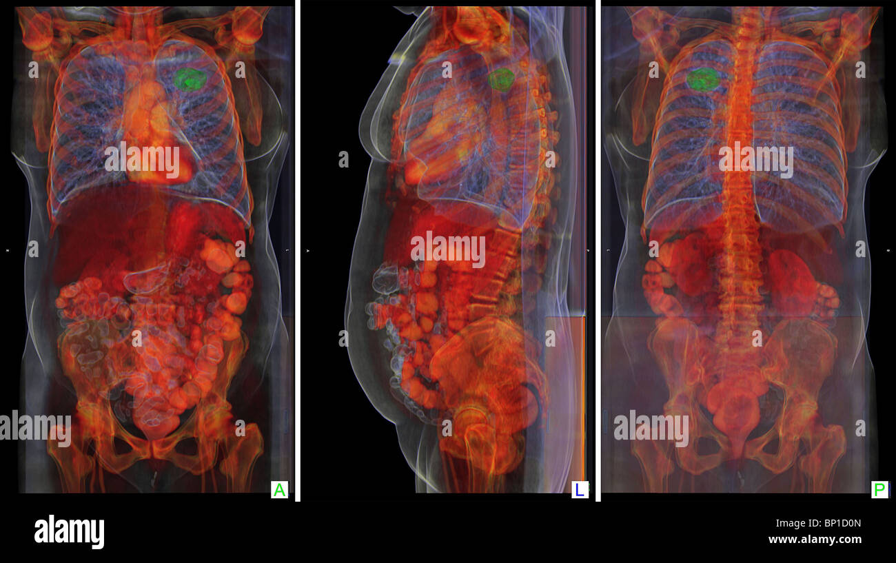 3D CT scan showing a cancer in the right lung of a 77 year old woman Stock Photo