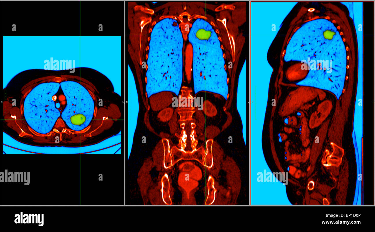 CT scan axial section showing a cancer in the right lung of a 77 year old woman Stock Photo