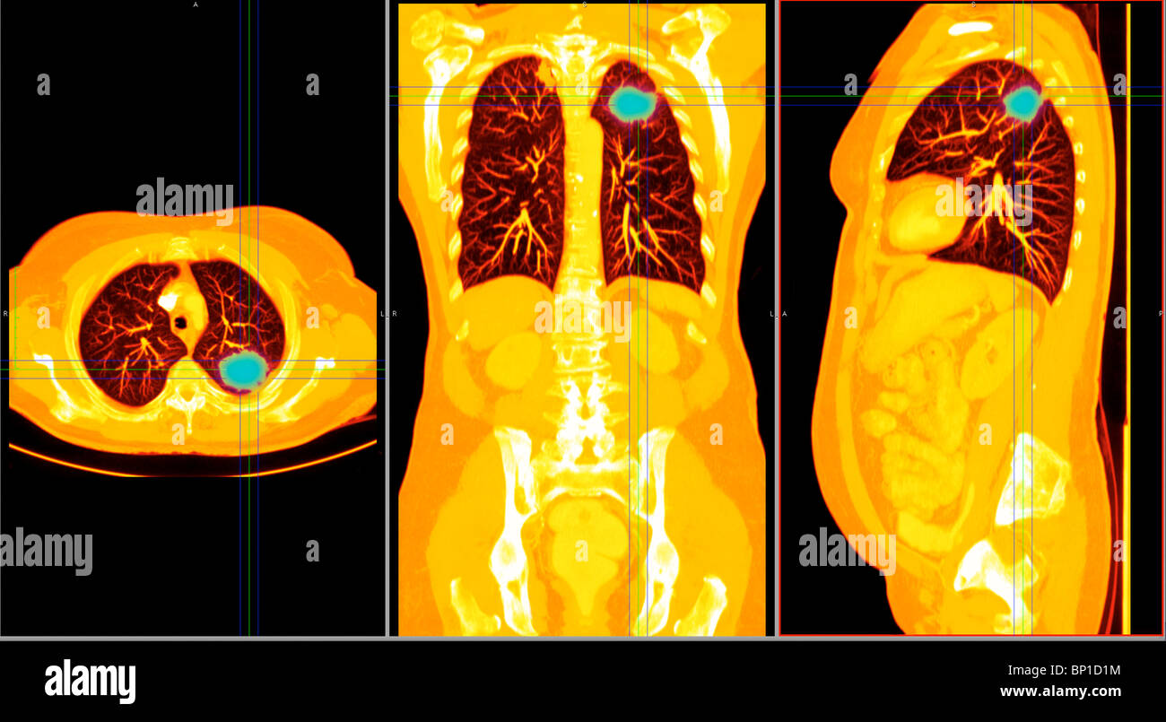 CT scan axial section showing a cancer in the right lung of a 77 year old woman Stock Photo