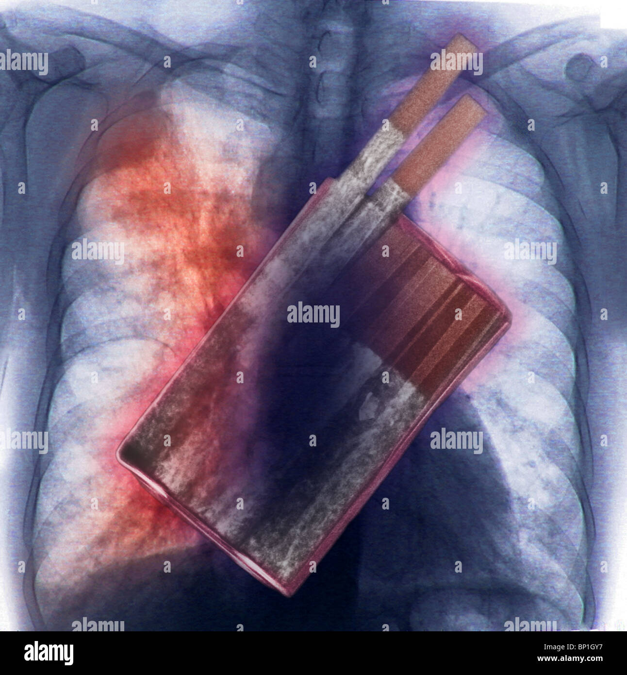 illustration of an x-ray of a pack of cigarettes superimposed over a chest x -ray showing lung cancer Stock Photo