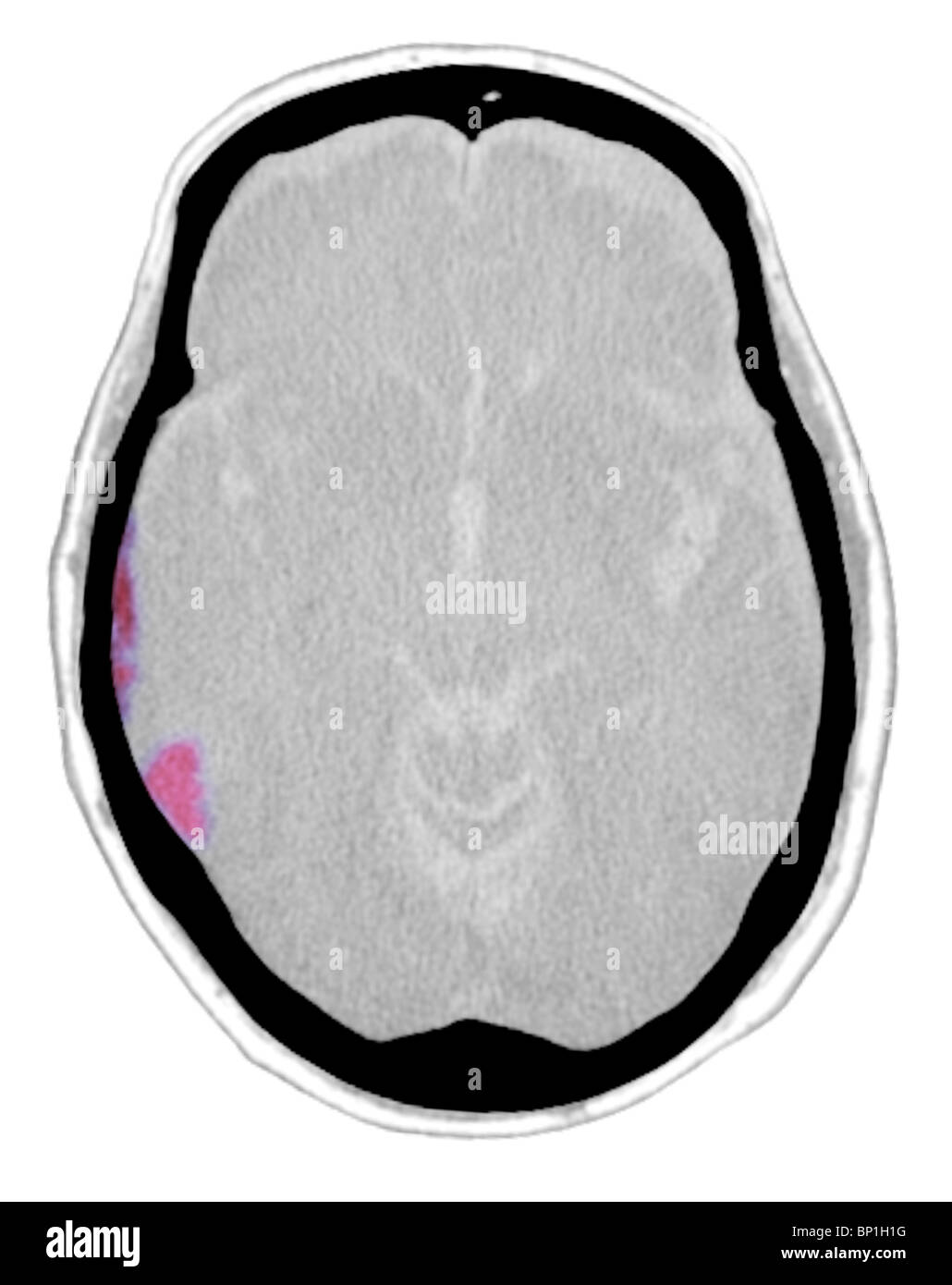 CT scan of the head of a 77 year old man showing an acute subdural hematoma Stock Photo