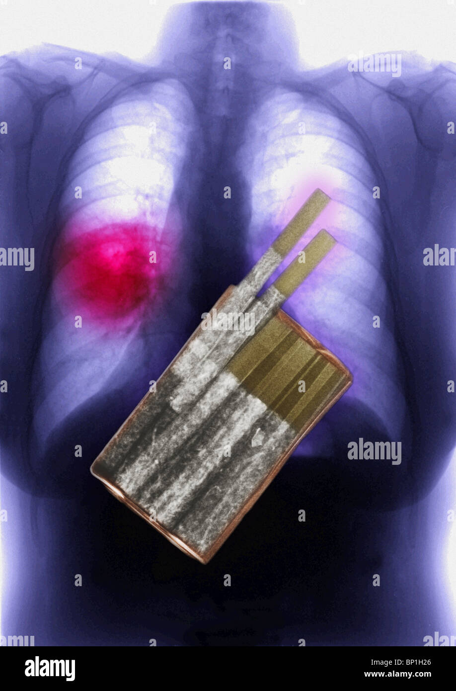 illustration of an x-ray of a pack of cigarettes superimposed over a chest x-ray showing lung cancer Stock Photo