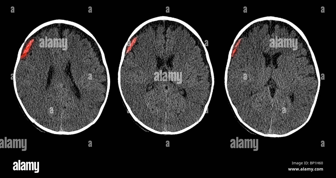 CT scan of the brain of a 6 month old child showing a subdural hematoma Stock Photo
