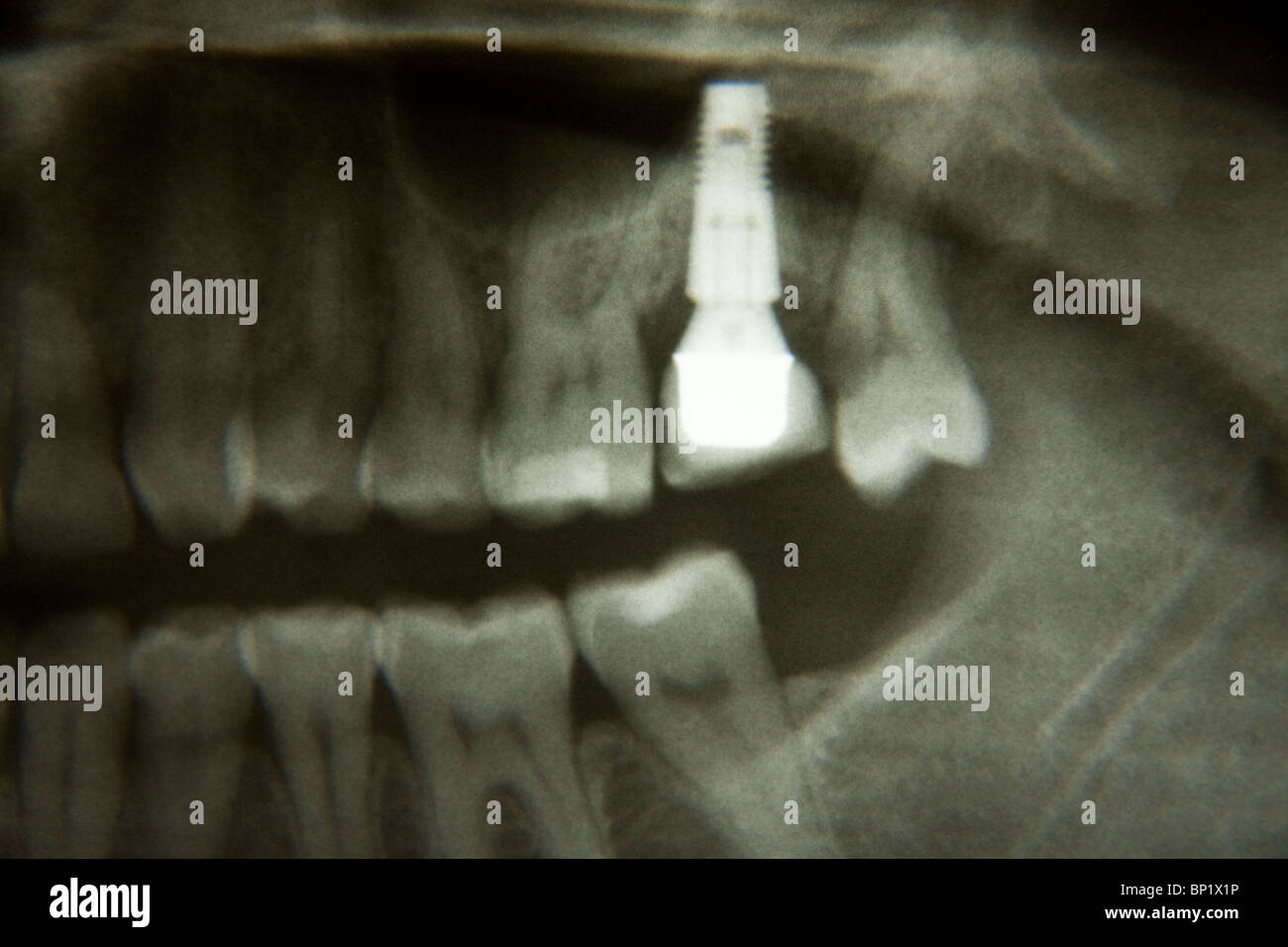 Dental Implant Xray