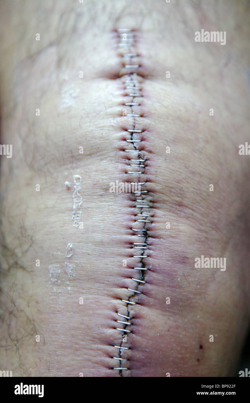 Cut and staples from knee replacement surgery Stock Photo