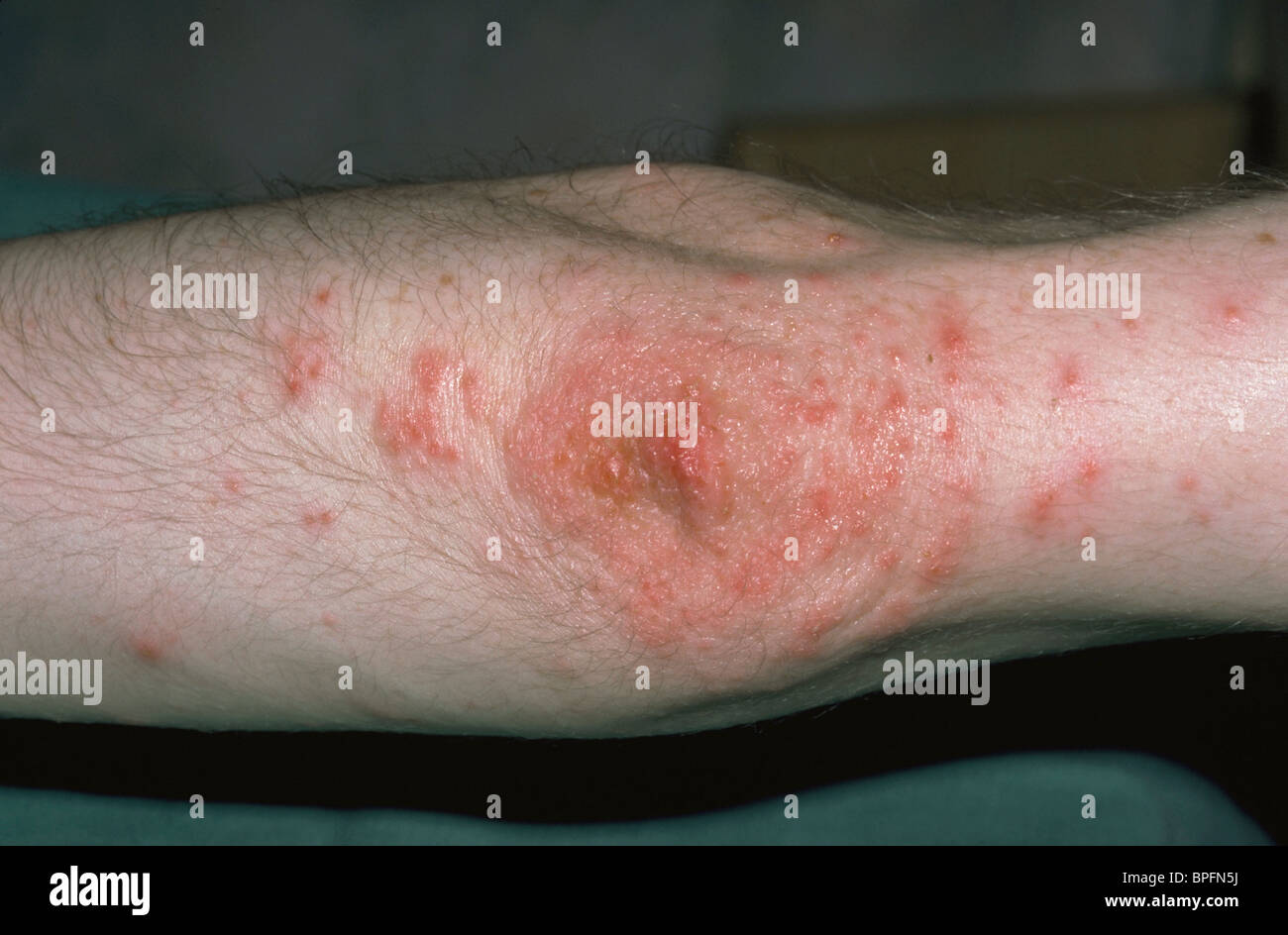 vasculitis on a human limb Stock Photo