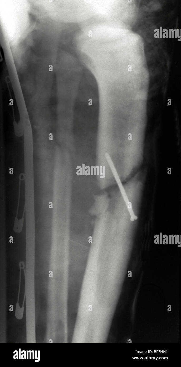 X ray showing breaks to the tibia, the long bone on the medial and pre-axial border of the leg, and to the fibula. Stock Photo