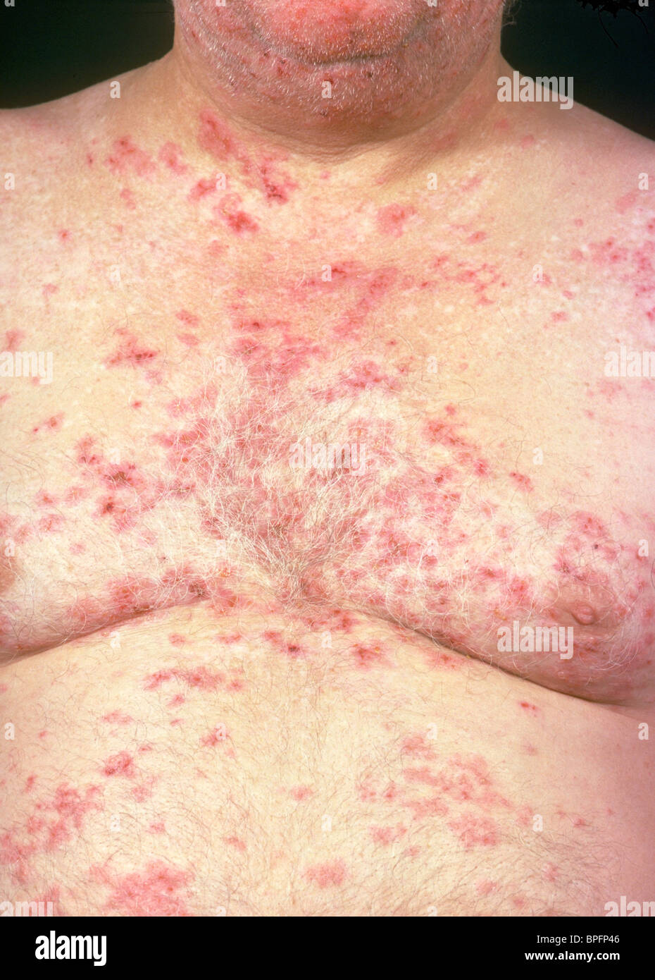 Dermatitis herpetiformis is a long-term skin disease with groups of itchy red bumps or blisters Stock Photo
