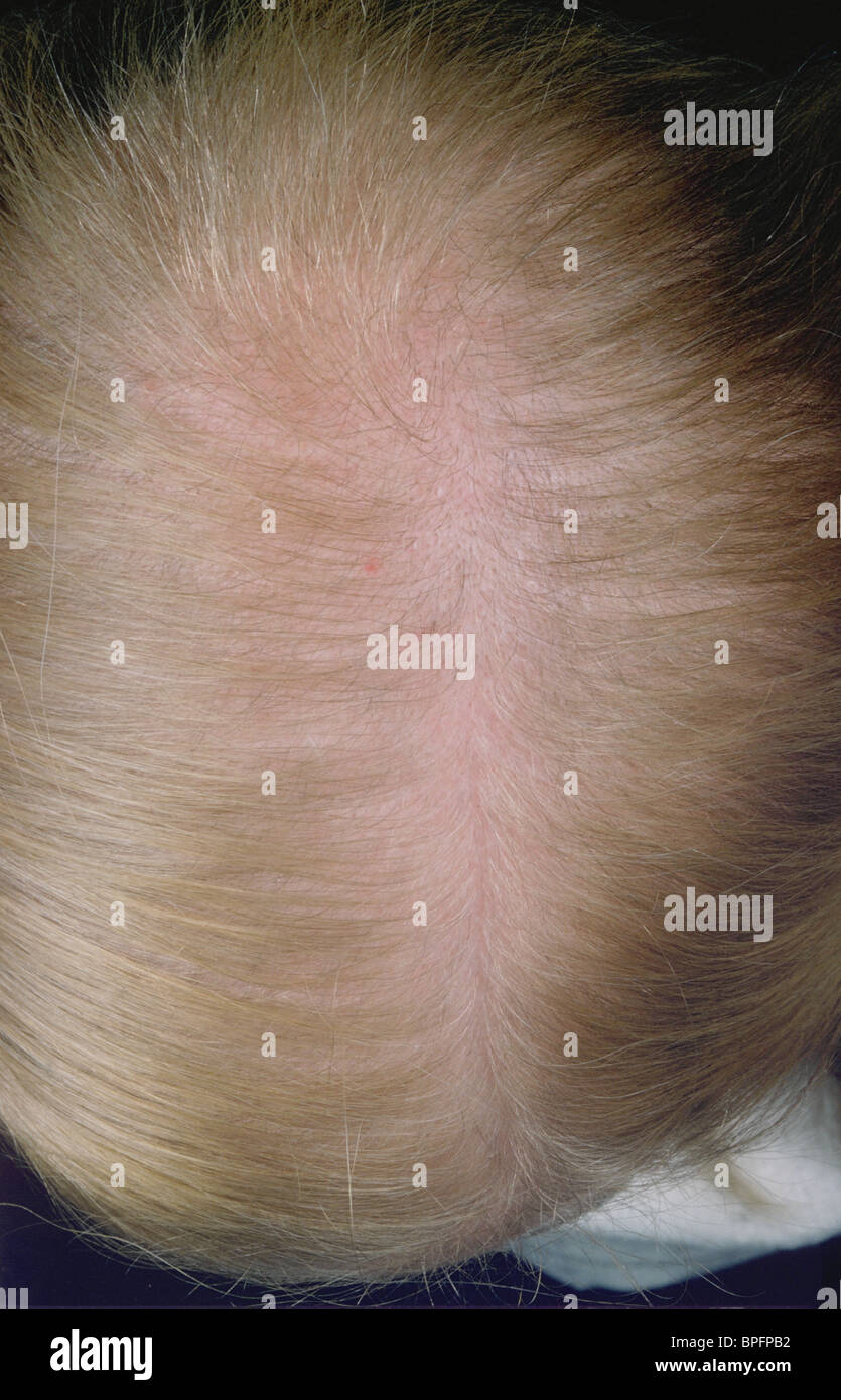 Scalp showing hair loss Stock Photo Alamy