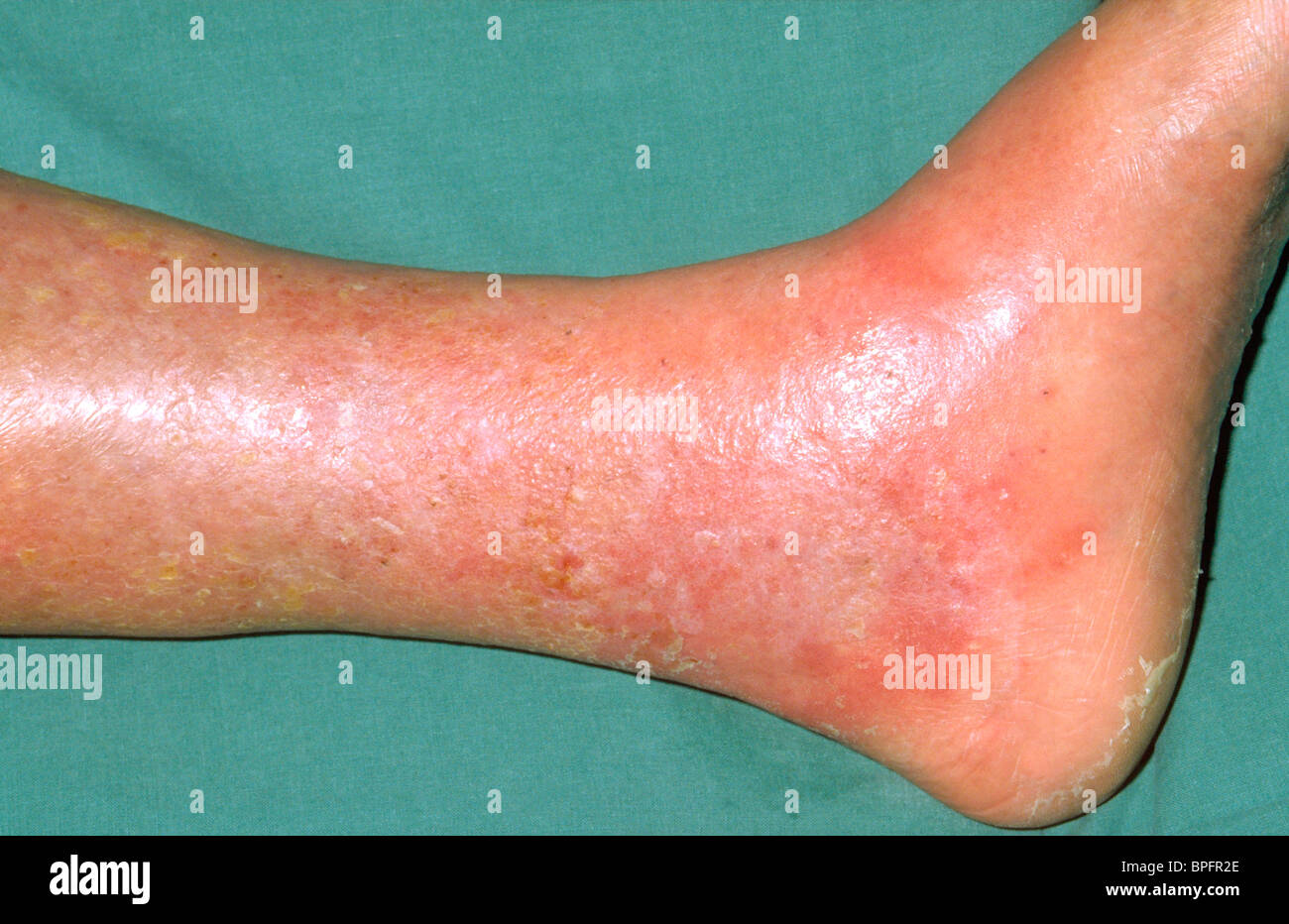An example of necrotic lesions on the leg in which the superficial epithelium is destroyed. Stock Photo