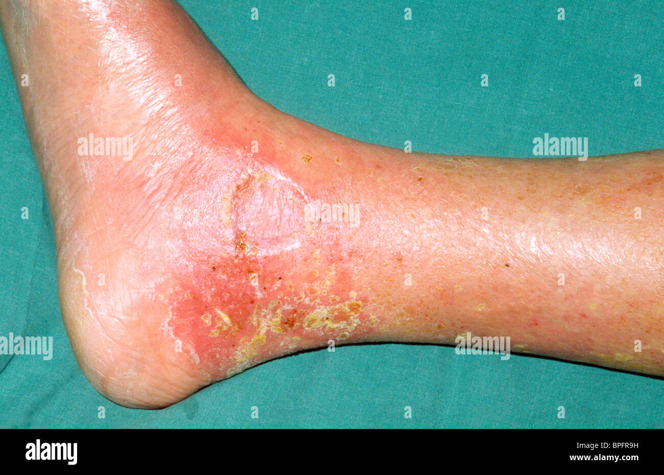 An example of necrotic lesions on the lower leg in which the superficial epithelium is destroyed and deeper tissues are exposed Stock Photo