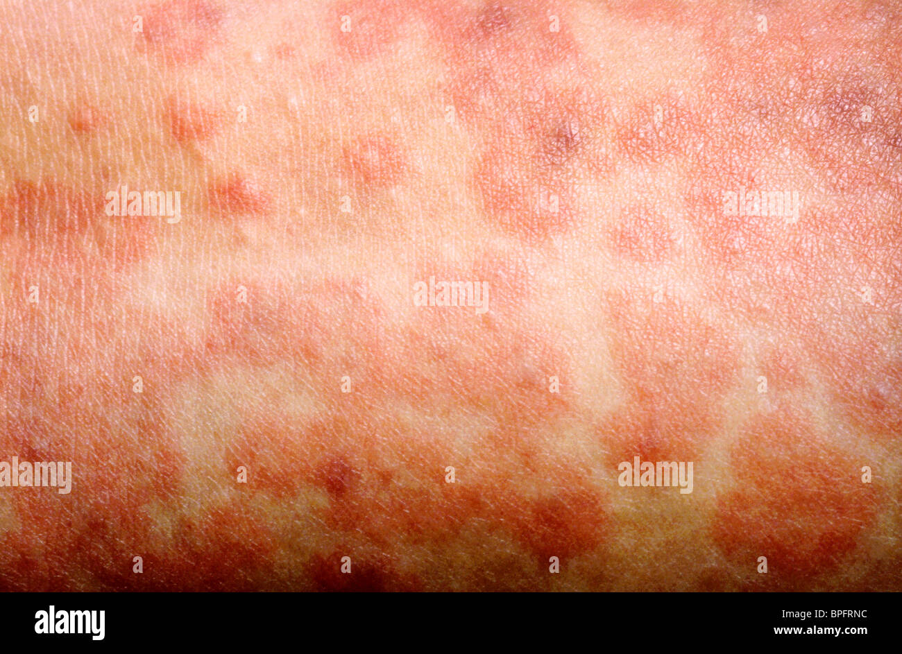 Maculopapular rash hires stock photography and images Alamy