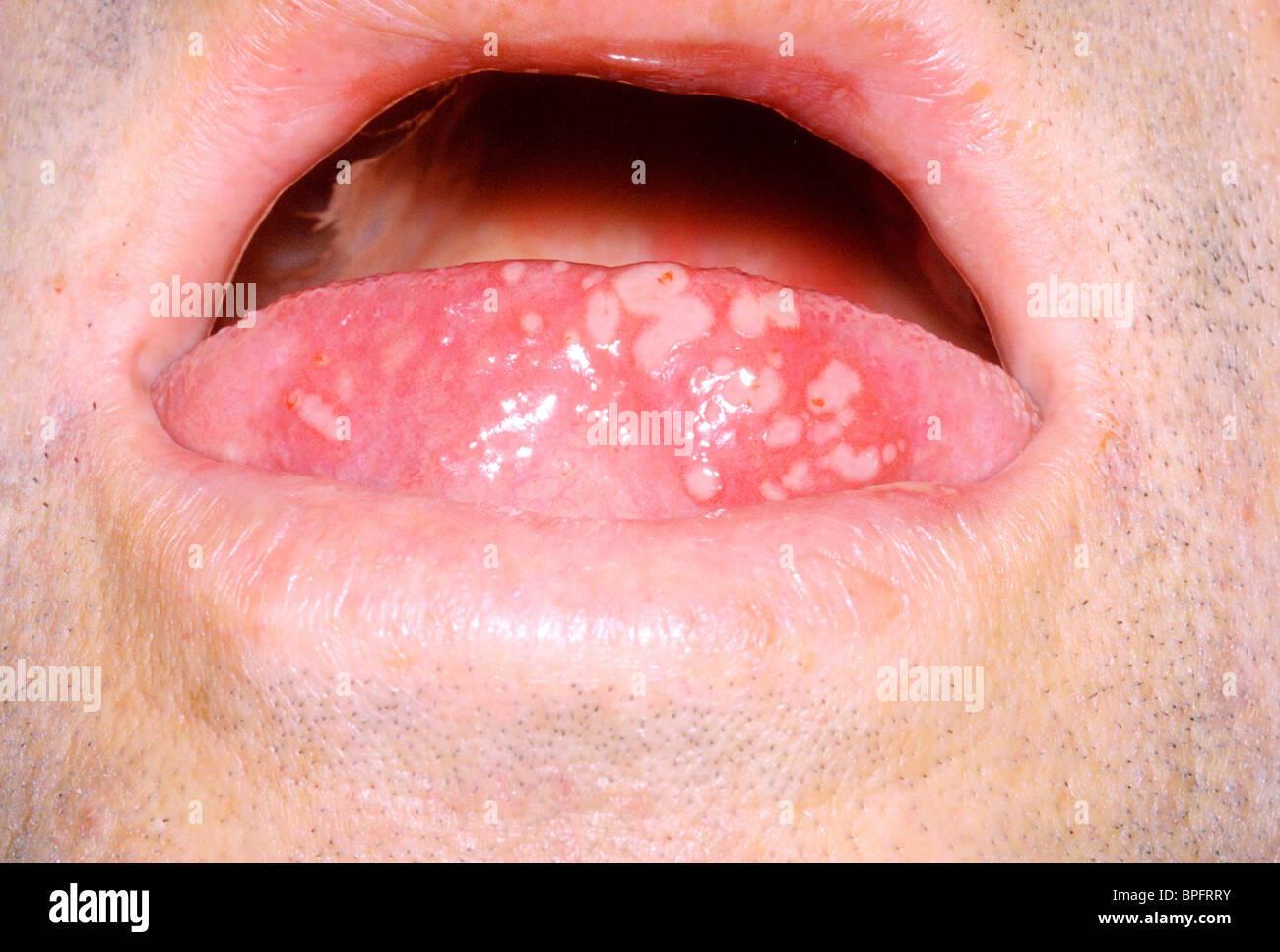 A picture of an acute vesicular eruption on the tongue caused by infection with herpes simplex virus. Stock Photo