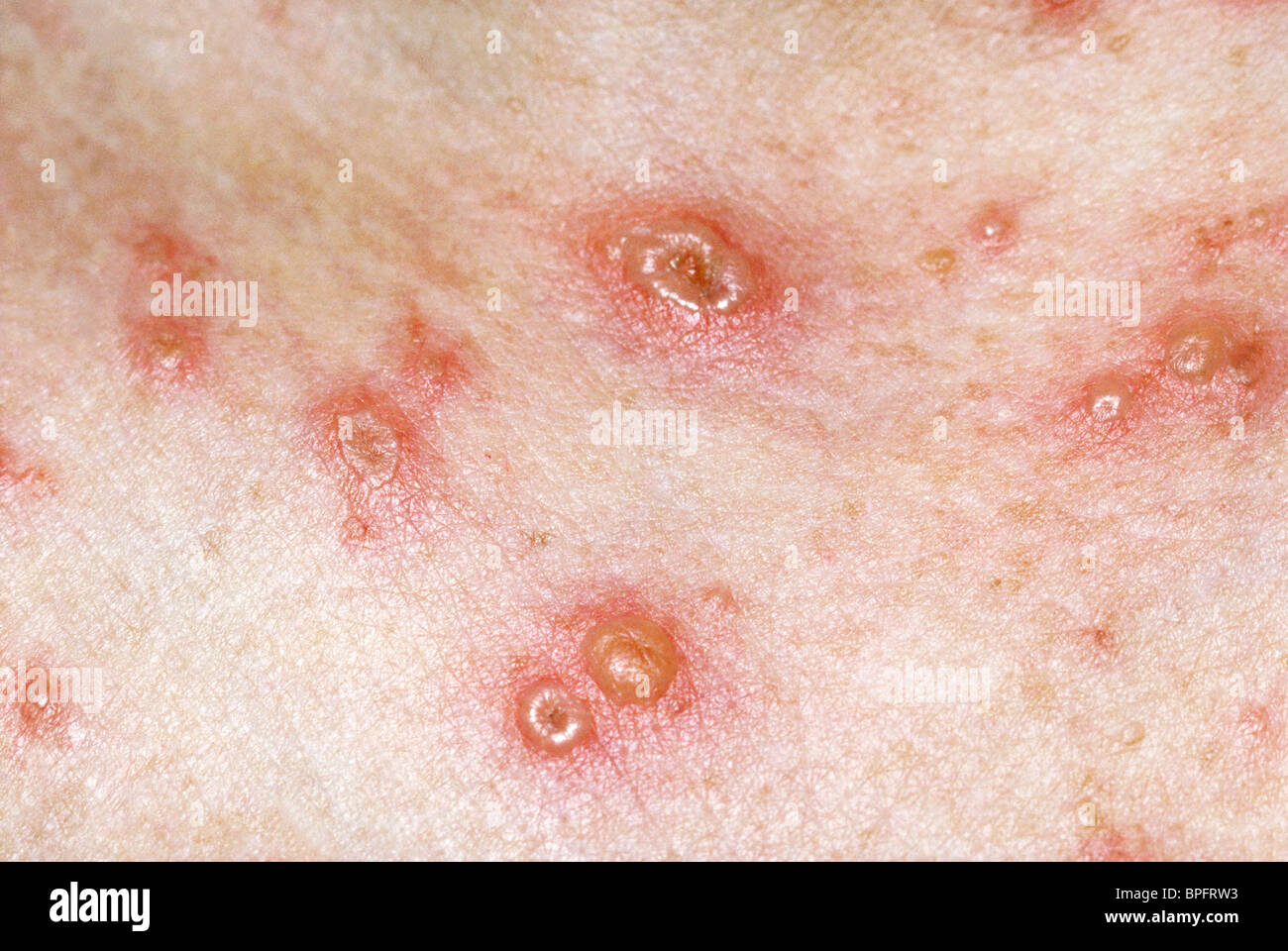 Varicella zoster viruses hi-res stock photography and images - Alamy