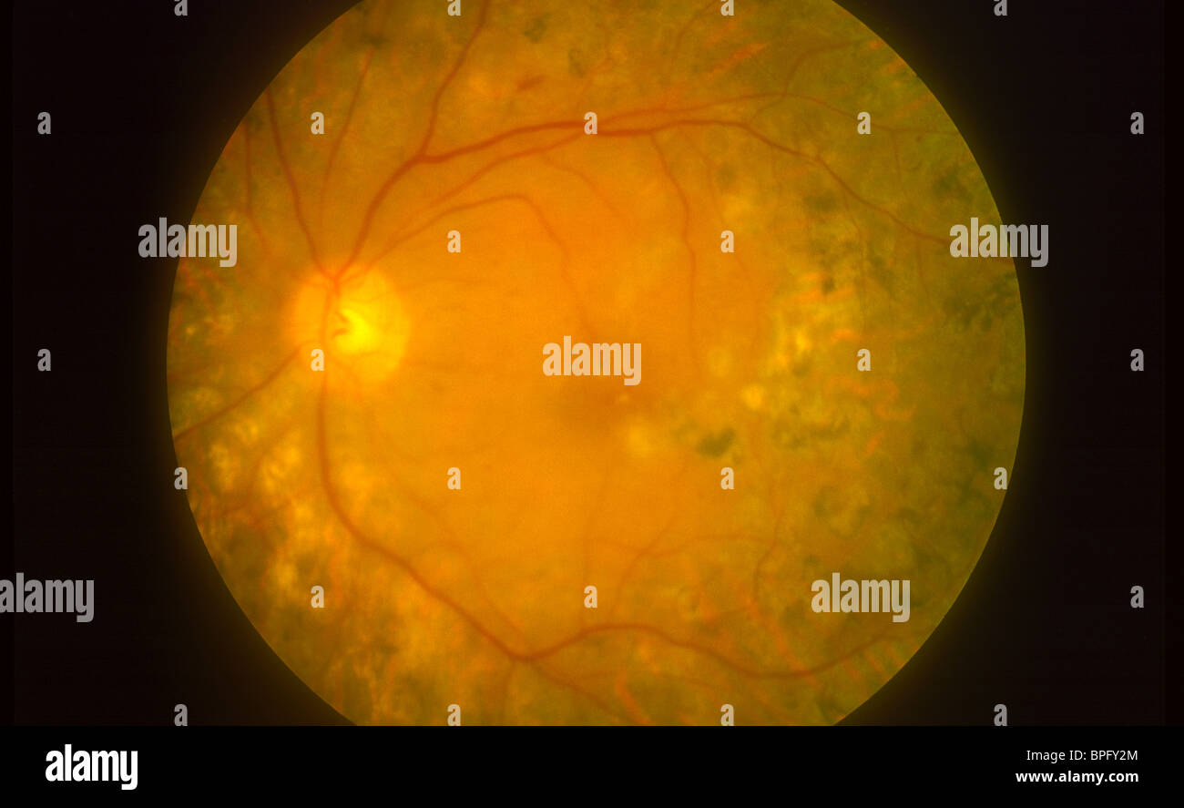 A retinal photograph showing diabetic retinopathy in the macular area showing the macula and optic disc. Stock Photo