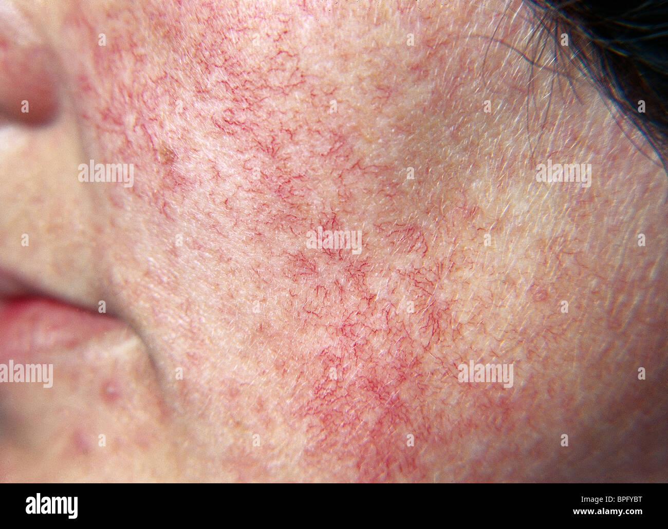 Telangiectasia Treatment