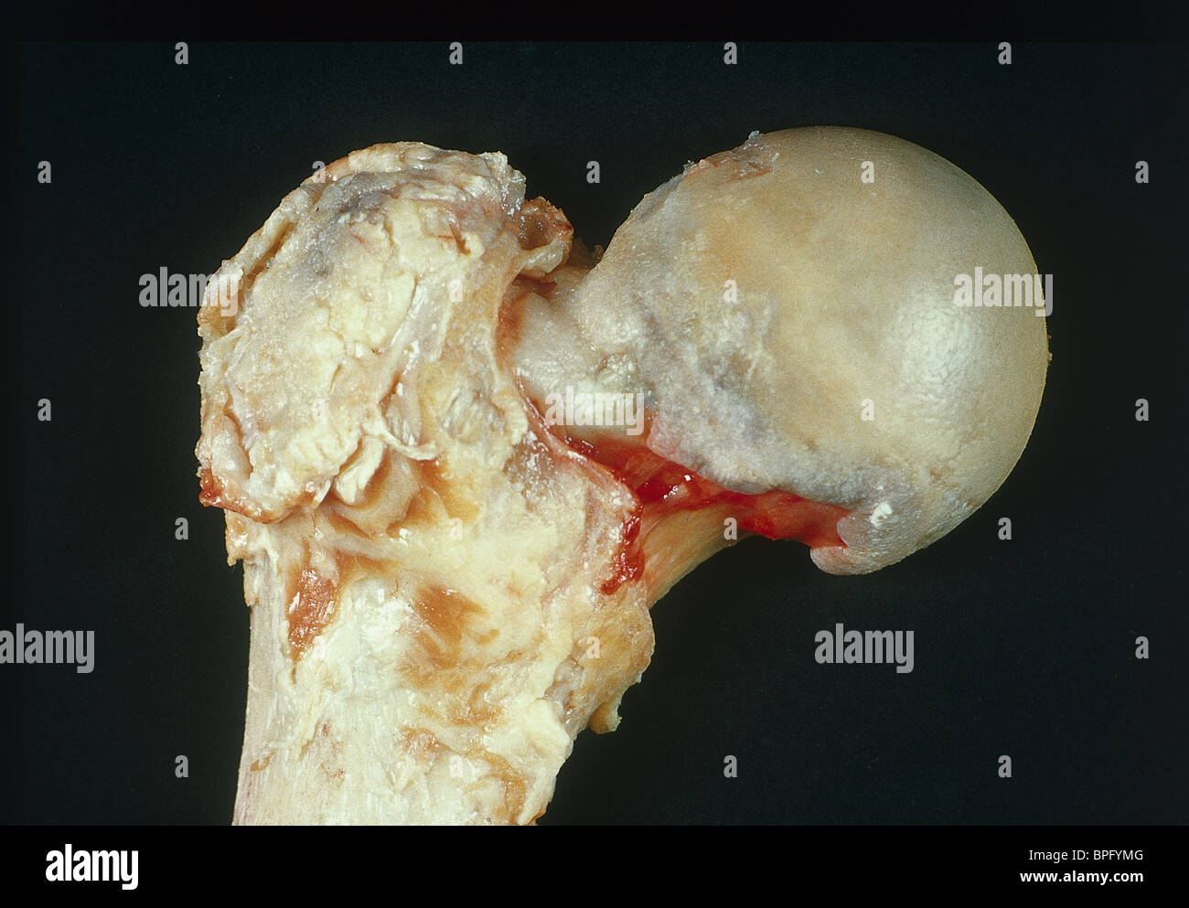 Osteoarthritis of the hip Stock Photo